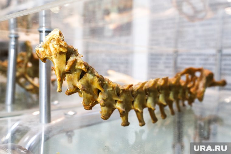 Что известно о болезни Бехтерева, приводящей к инвалидности: симптомы, стадии, способы лечения