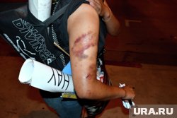 Чем опасны обычные, на первый взгляд, синяки на теле: от воспалений до ампутации конечностей